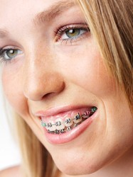 Jiaonan Adult Braces - Jiaonan Adult Orthodontics Guide