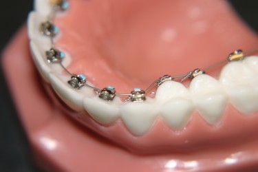 Whittier CA Lingual Braces - Whittier CA Lingual Orthodontics Guide